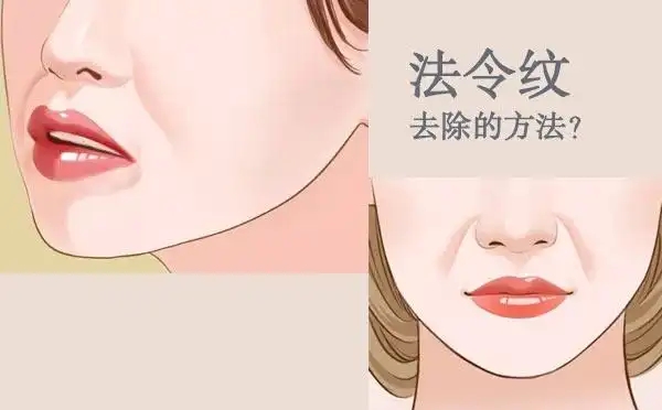 玻尿酸祛法令纹的注意事项(医美用什么方式拯救法令纹) 玻尿酸祛法令纹的注意事项(医美用什么方式拯救法令纹)