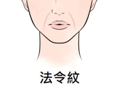 注射玻尿酸去法令纹几天能消肿恢复正常(热玛吉对法令纹效果怎么样)