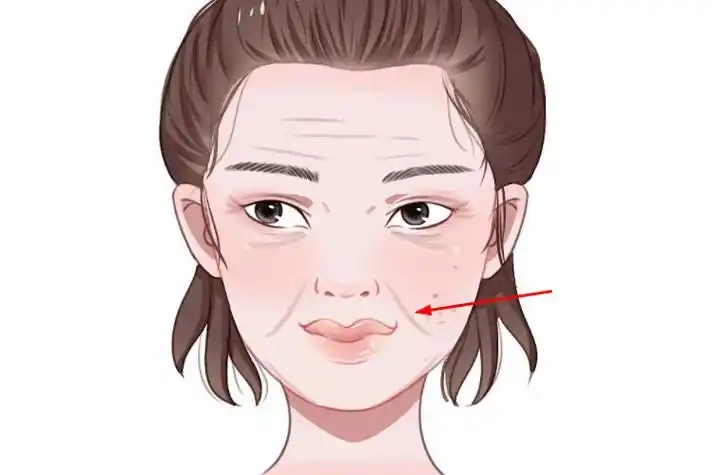 如何防治法令纹(皮肤+脂肪松弛引起的法令纹要怎么解决) 如何防治法令纹(皮肤+脂肪松弛引起的法令纹要怎么解决)