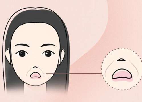 去除法令纹项目如何选择(自体脂肪填充法令纹注意事项)