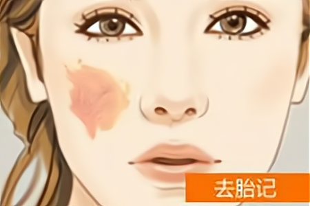 激光去胎记多大可以做(激光去胎记要治疗几次干净)