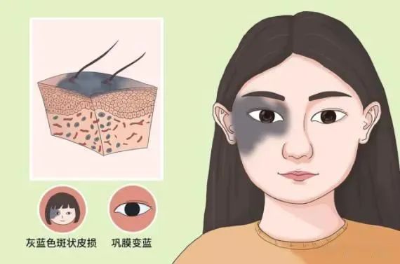 激光去胎记有什么优点呢(激光去胎记需要做几次)