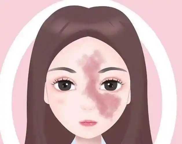 激光去胎记多大可以做(激光去胎记需要多少钱)