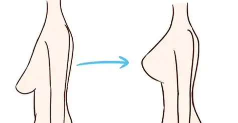 乳房下垂矫正术有效果吗(乳房下垂矫正治疗方法)