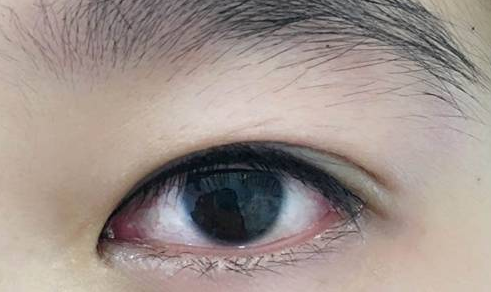 割双眼皮注意事项有哪些(割双眼皮恢复时间因素)