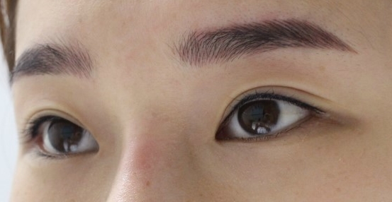 双眼皮手术利弊分析(割双眼皮什么时候合适)