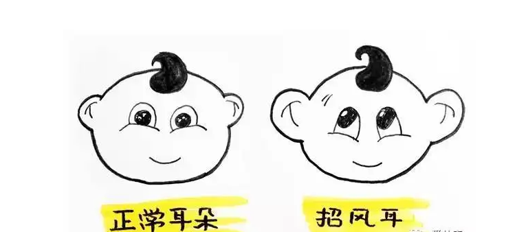 招风耳矫正多少钱(招风耳矫正术后恢复时间)