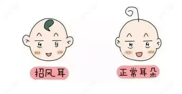 招风耳矫正要多少钱(招风耳矫正的注意事项)